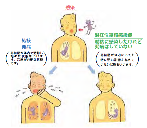 感染と発病の違い