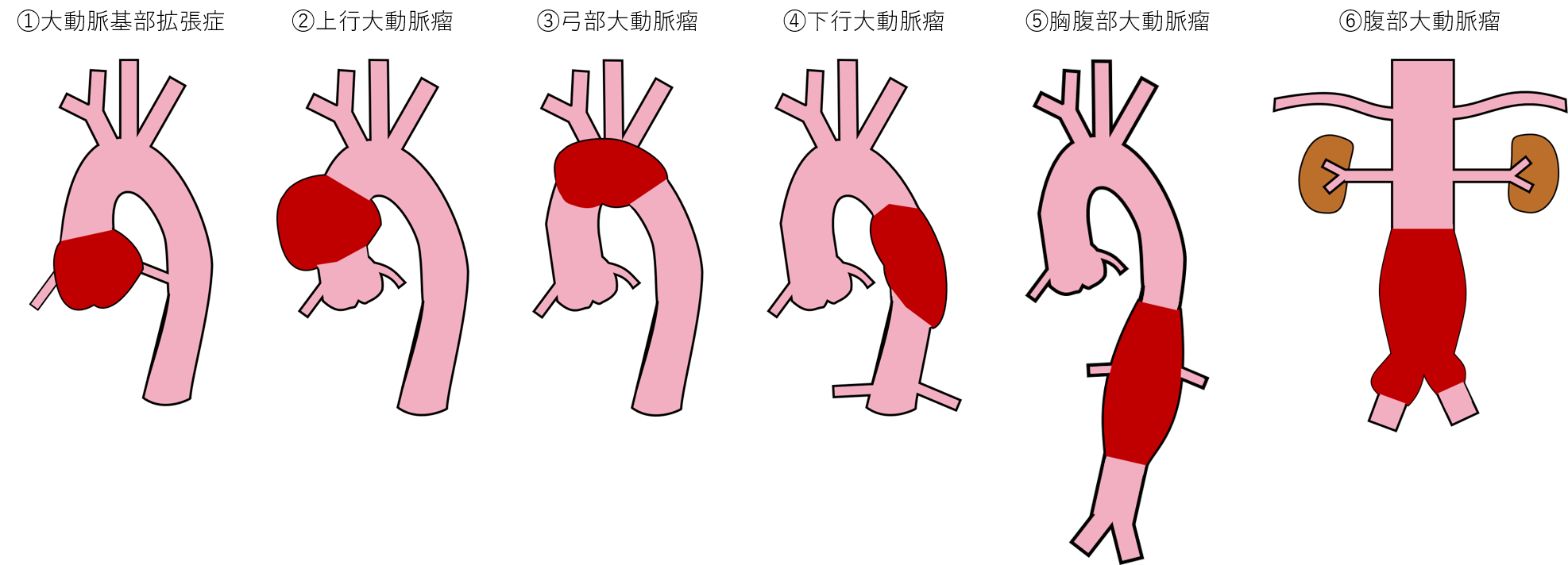 大動脈瘤のイメージ図
