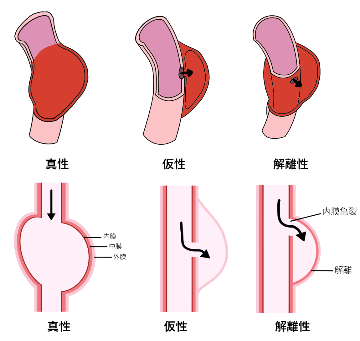 大動脈解離のイメージ図