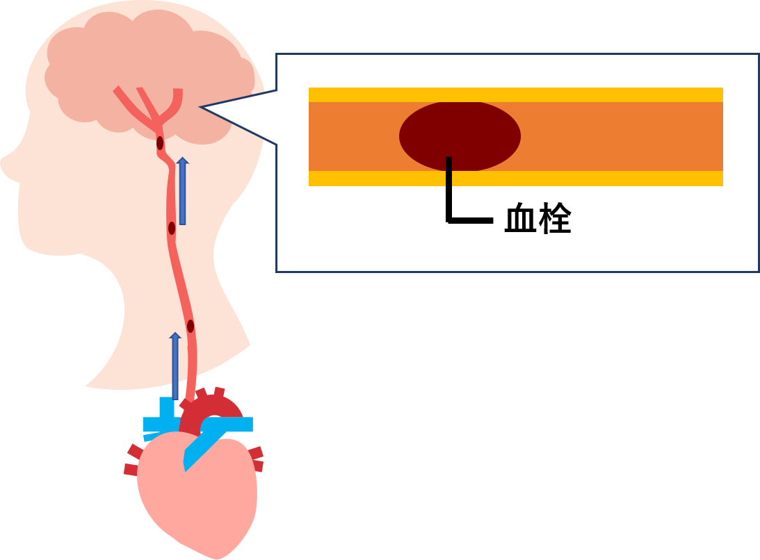 ラクナ梗塞のイメージ図