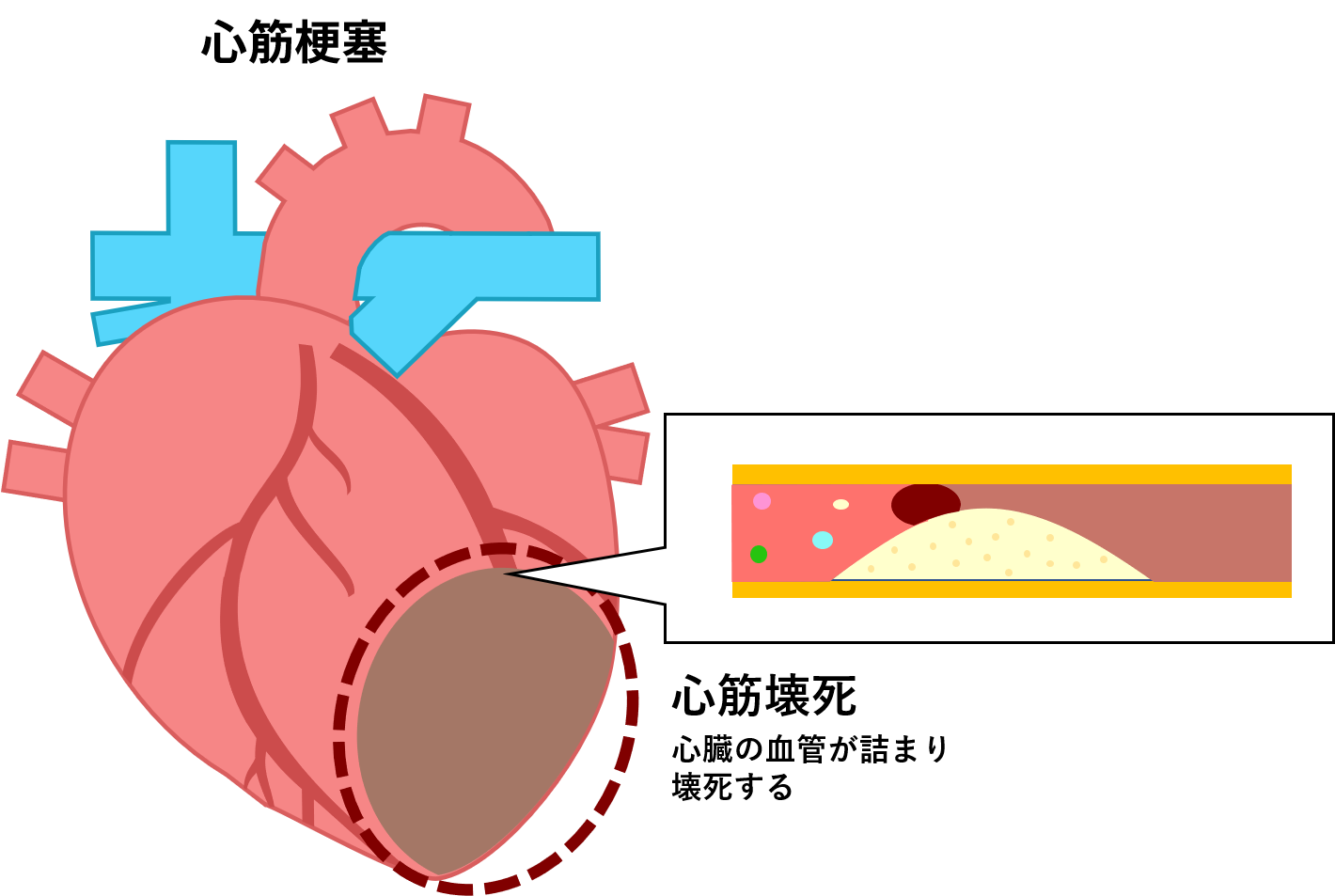 心筋梗塞のイメージ図