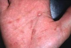 写真2　梅毒の第二期発疹