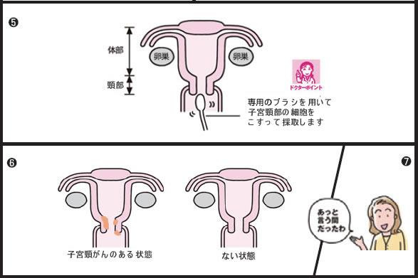 子宮がん検診
